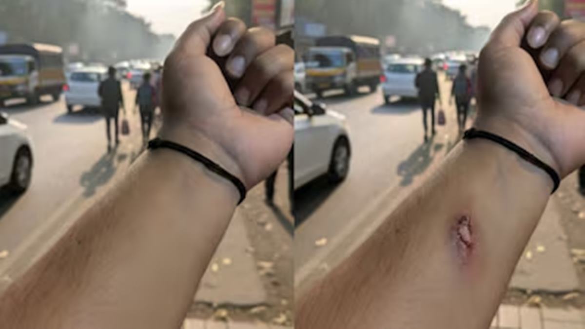 ‘I Fell From Bike, Need Leave...’: Employee Sends Serious Injury Photo To HR, But The Truth Is Far From What It Seems